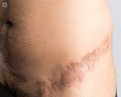 Scar Healing Ask An Expert