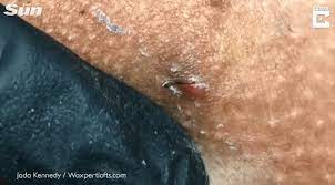 Sometimes, the ingrown hair is visible in the swollen red bump. Grim Video Shows Pus Stream Out Of Woman S Bikini Line As Ingrown Hairs Are Pulled Out