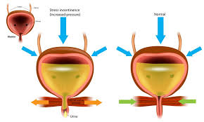 Image result for Stress Incontinence