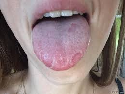 Image result for Puchýře na jazyku