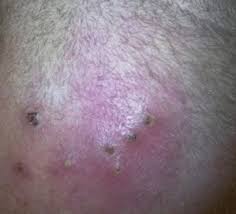 While pubic ingrown hair cysts are more common in females. Ingrown Pubic Hair Cyst Infected Get Rid Of It Treatment And Pictures Healthrid