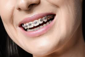Can Orthodontics for Facial Growth Enhance Your Jaw Structure?