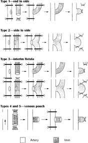 Colonic suture, compression anastomosis, compression suturing device. End To Side Anastomosis An Overview Sciencedirect Topics