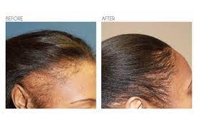What it will do is keep your hair and scalp healthy, preventing hair loss and lending a nice shine. Hair Regrowth Solution For All Hair Types Contains Pumpkin Seed Extract Msm Vitamin C Biotin Collagen P Hair Regrowth Hair Growth Serum Biotin Hair Growth