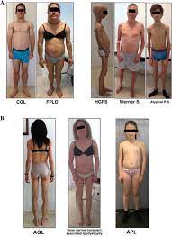 Brunzell jd, shankle sw, bethune je. Diagnosis And Treatment Of Lipodystrophy A Step By Step Approach Springerlink