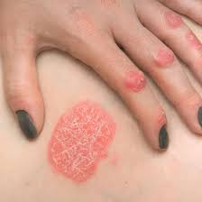 Image result for psoriasis