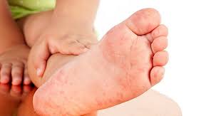 Causes Of Skin Rash And Home Remedies For Skin Rashes Itchy Skin Rash