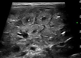 Image result for Necrotizing Enterocolitis