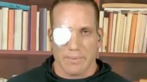 What happened to AJ Hawk's face?