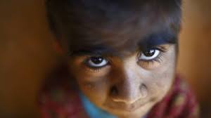 Human werewolf syndrome is an extremely rare condition. Family With Werewolf Syndrome Undergo Laser Treatment Itv News