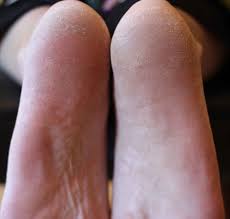 You may experience some itching feeling when you submerge your foot inside the epsom salt water. Pretty Summer Feet Care