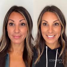 Botox discounts in Peabody and Middleton CosmeticsMD