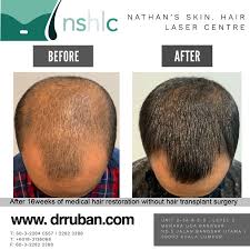 Delivers the nutrients (such as protein, peptide, growth factors) to deeper scalp area to help. Dr Ruban S Skin Hair Clinic In Kuala Lumpur Malaysia Read 6 Reviews