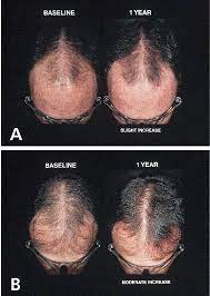 Additional hair loss at the crown area appears along with further recession of the frontal hairline and hair the temple areas. Finasteride In The Treatment Of Men With Frontal Male Pattern Hair Loss Sciencedirect