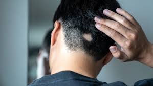 The word alopecia means hair loss.a person with alopecia universalis loses all their hair, including eyebrows and eyelashes, facial hair, body hair, and hair on the head. Surprising Things Your Body Hair Is Trying To Tell You