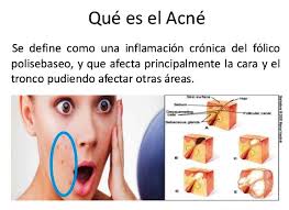 ACNÉ ¿Qué es el acné? El acné es un... - Consultorio Médico Dr. Mario A  Carrillo | Facebook