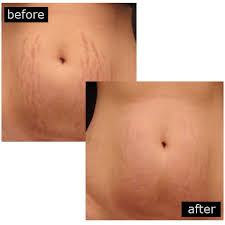 Stretch mark removal camouflage covers up by dreambody. Stretch Marks Removal Treatments In Birmingham By Designing Faces