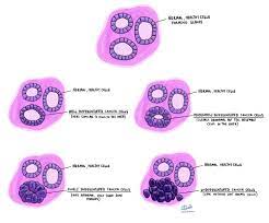 Something just went wrong, and they overgrew and produced a lump. Poorly Differentiated Pathology Dictionary Mypathologyreport Ca