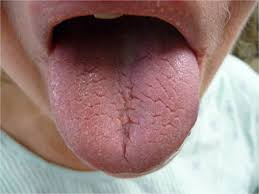 Sjogren S Syndrome Dermatology Advisor