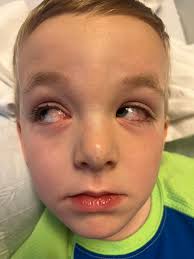 What does the keratin 5 gene mean for EBS? Can a non-EBS carrier be tested?