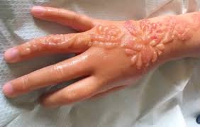 Ada 175 lebih motif inilah koleksi lengkap gambar henna tangan dan kaki yang simple, cantik, dan mudah dibuat untuk di indonesia, henna atau yang biasa dikenal dengan pacar/inai, hanya dilukis sederhana pada bagian. Bernas Id Karena Lukis Tato Henna Gadis Kecil Ini Cacat Permanen