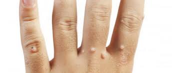Image result for verrucae filiformes