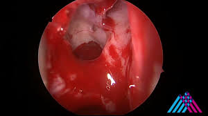 Image result for Sinus Surgery