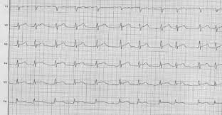 Eine herzmuskelentzündung (myokarditis) ist ein akuter oder ein chronisch verlaufender entzündungsprozess im herzmuskel. Myokarditis News Papers