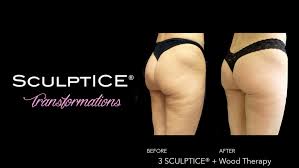Time between before & after pictures: Body Contouring Faq Hidden Gem Luxury