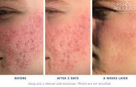 How To Get Rid Of Dry Skin Caused By Harsh Acne Treatments Renee Rouleau