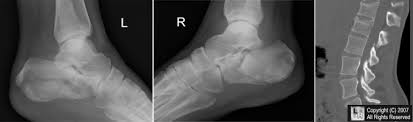 Image result for Calcaneus Compression Fracture