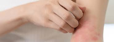 Image result for dermatitis contacta toxica