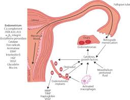 An overview of cochrane reviews. Endometriosis The Lancet
