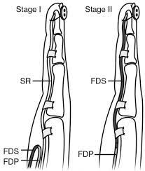 The tendons of the flexor digitorum superficialis (fds) and profundus (fdp) and the flexor pollicis longus (fpl) pass through this tunnel together with the median nerve. Flexor Tendon Injuries Hand Orthobullets