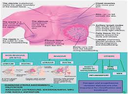 Each is distinguished by the origin of the cancer cells and whether it has the potential to spread. Morphology And Medical Illustration Of The Various Types Of Breast Cancer Download Scientific Diagram