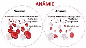 Eisenmangel Erkennen Heimtest Schnelltests De