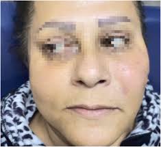 Image result for phlegmon on face)