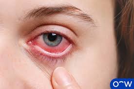 Image result for Eye Pain