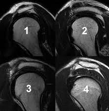 •morphologie des akromions (typ 3 nach bigliani). Acromial Types Radiology Reference Article Radiopaedia Org