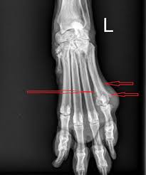 Bone cancer usually occurs in children and adolescents, rarely experienced by adults. Why Did Reagan Have A Toe Removed Dr Phil Zeltzman S Blog