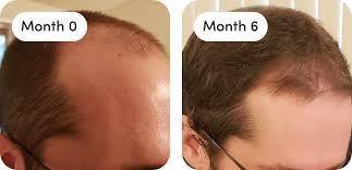does hims hairloss treatment actually work
