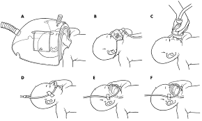 High‐flow nasal cannula (hfnc) supportive therapy exerts its potential benefits through a variety of mechanisms. Oxygen Administration In Infants Adc Fetal Neonatal Edition