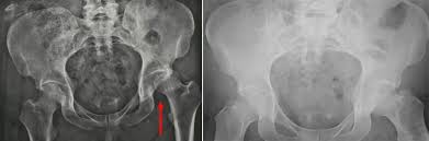 Check spelling or type a new query. Hip Dislocation Orthoinfo Aaos
