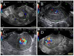 Ultrasound obstet gynecol sent rpoc. Ultrasonographic Patterns Of Rpoc Gutenberg Classification A Type 0 Download Scientific Diagram