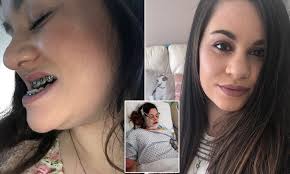 Holly Everson-Bullock has jaw realigned after underbite left her unable to  eat