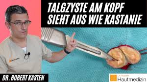 Talgdrusen Entfernen Am Kopf So Geht Es Dr Kasten Hautmedizin In Mainz Youtube