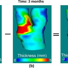 Maybe you would like to learn more about one of these? Pdf Development Of 3d Ultrasound Techniques For Carotid Artery Disease Assessment And Monitoring