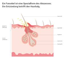 Ein nasenfurunkel bezeichnet eine eitrige entzündung an nasenspitze oder naseneingang, die sich aus einer haarbalgentzündung entwickelt. Furunkel Ursachen Erfolgreich Behandeln Vorbeugen