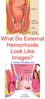 What To Use For Hemorrhoids Bleeding Hemorrhoids Hemorrhoids Treatment Hemorrhoids