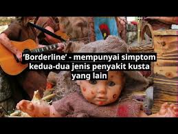 Penyebab utama dari penyakit kusta yang anda derita adalah infeksi bakteri mycobacterium leprae. Penyakit Kusta Leprosy Punca Simptom Dan Rawatan Doctoroncall